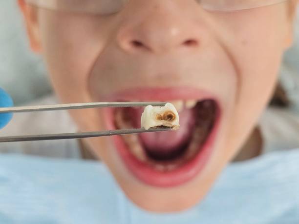 Best Emergency Dental Care for Broken or Chipped Teeth in South Bound Brook, NJ